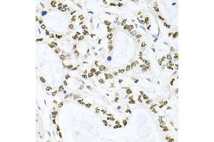 Immunohistochemistry of paraffin-embedded human gastric cancer using BCCIP antibody (ABIN5995871) at dilution of 1/100 (40x lens). (BCCIP Antikörper)