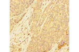 Immunohistochemistry of paraffin-embedded human ovarian cancer using ABIN7168417 at dilution of 1:100 (PDE6A Antikörper  (AA 656-860))