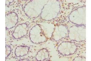 Immunohistochemistry of paraffin-embedded human colon cancer using ABIN7167630 at dilution of 1:100 (FAM82B Antikörper  (AA 13-314))