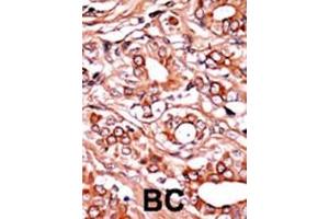 Formalin-fixed and paraffin-embedded human cancer tissue reacted with the primary antibody, which was peroxidase-conjugated to the secondary antibody, followed by AEC staining. (ABL1 Antikörper  (pTyr134))