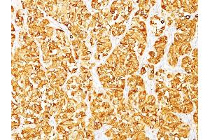 Formalin-fixed, paraffin-embedded human Melanoma stained with MART-1 Monoclonal Antibody (M2-7C10). (MLANA Antikörper)