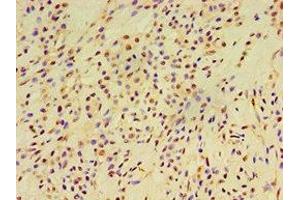 Immunohistochemistry of paraffin-embedded human breast cancer using ABIN7152252 at dilution of 1:100 (EXOC2 Antikörper  (AA 1-220))