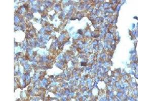 Formalin-fixed, paraffin-embedded human ovarian carcinoma stained with CD99 antibody (MIC2/877). (CD99 Antikörper)