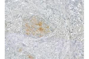 ABIN6258387 and ABIN6274993 at 1/100 staining human tongue carcinoma by IHC-P.
