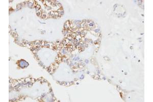 IHC-P Image Immunohistochemical analysis of paraffin-embedded human ovarian cancer, using CD146, antibody at 1:500 dilution. (MCAM Antikörper  (N-Term))