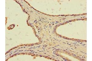 Immunohistochemistry of paraffin-embedded human prostate cancer using ABIN7172291 at dilution of 1:100 (TLL1 Antikörper  (AA 522-643))