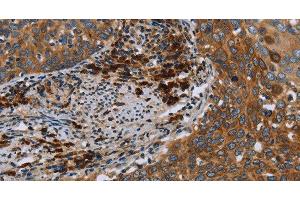 Immunohistochemistry of paraffin-embedded Human cervical cancer using HYAL3 Polyclonal Antibody at dilution of 1:40 (HYAL3 Antikörper)