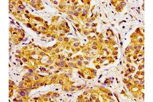 Immunohistochemistry of paraffin-embedded human liver cancer using ABIN7170770 at dilution of 1:100 (CYP27A1 Antikörper  (AA 290-407))