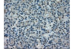 Immunohistochemical staining of paraffin-embedded Carcinoma of thyroid tissue using anti-PORmouse monoclonal antibody. (POR Antikörper)