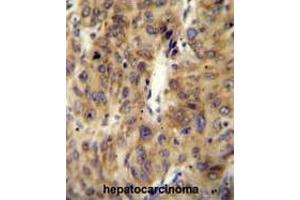 ACF Antibody (C-term) immunohistochemistry analysis in formalin fixed and paraffin embedded human hepatocarcinoma followed by peroxidase conjugation of the secondary antibody and DAB staining. (A1CF Antikörper  (C-Term))