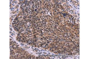 Immunohistochemistry of Human colon cancer using CDC5L Polyclonal Antibody at dilution of 1:30