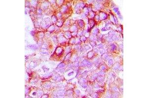 Immunohistochemical analysis of EPHB1/2 staining in human breast cancer formalin fixed paraffin embedded tissue section. (EPHB1/2 Antikörper)