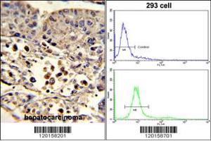 (LEFT)Formalin-fixed and paraffin-embedded human hepatocarcinoma reacted with ETHE1 Antibody , which was peroxidase-conjugated to the secondary antibody, followed by DAB staining. (ETHE1 Antikörper  (C-Term))