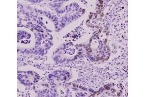 Immunohistochemistry paraffin embedded sections of human colorectal cancer tissue were incubated with SUMO2 monoclonal antibody, clone AT10F1  (1 : 50) for 2 hours at room temperature. (SUMO2 Antikörper  (AA 1-93))