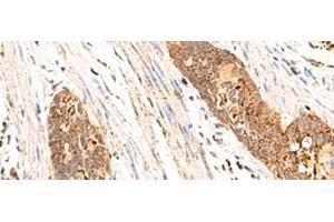 Immunohistochemistry of paraffin-embedded Human esophagus cancer tissue using CYYR1 Polyclonal Antibody at dilution of 1:85(x200) (CYYR1 Antikörper)