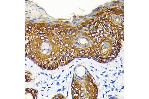Immunohistochemistry of paraffin-embedded human skin cancer using Cytokeratin 14 (KRT14) (KRT14) Rabbit mAb (ABIN7268091) at dilution of 1:100 (40x lens). (KRT14 Antikörper)