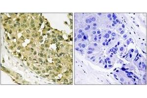 Immunohistochemistry analysis of paraffin-embedded human breast carcinoma, using STMN1 (Phospho-Ser62) Antibody.