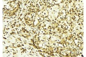 ABIN6267618 at 1/100 staining Human breast cancer tissue by IHC-P.