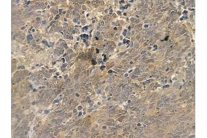 ABIN6262671 and ABIN6273002 at 1/100 staining human small cell lung carcinoma by IHC-P. (ISCU Antikörper  (Internal Region))