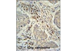 C19orf50 Antibody (Center) (ABIN653085 and ABIN2842681) immunohistochemistry analysis in formalin fixed and paraffin embedded human lung carcinoma followed by peroxidase conjugation of the secondary antibody and DAB staining. (C19orf50 Antikörper  (AA 59-85))