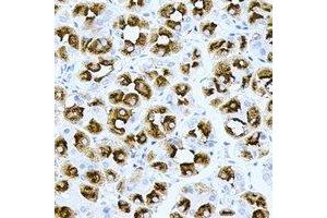 Immunohistochemical analysis of H-Ras staining in human gastric cancer formalin fixed paraffin embedded tissue section. (HRAS Antikörper)
