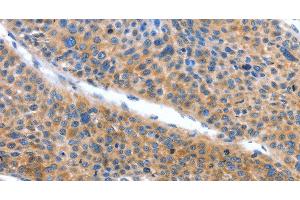 Immunohistochemistry of paraffin-embedded Human liver cancer tissue using ARL11 Polyclonal Antibody at dilution 1:50 (ARL11 Antikörper)