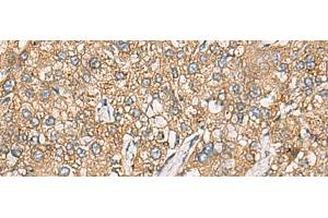Immunohistochemistry of paraffin-embedded Human liver cancer tissue using CHKA Polyclonal Antibody at dilution of 1:35(x200) (Choline Kinase alpha Antikörper)