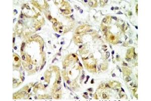 Human stomach cancer tissue was stained by rabbit Anti-Spexin prepro (36-58)  Antibody (Spexin Antikörper  (Preproprotein))