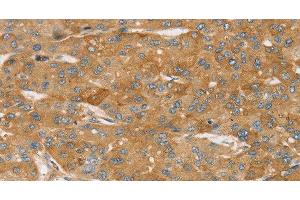 Immunohistochemistry of paraffin-embedded Human liver cancer using TPD54 Polyclonal Antibody at dilution of 1:35