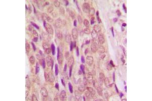 Immunohistochemical analysis of SMAD4 staining in human breast cancer formalin fixed paraffin embedded tissue section. (SMAD4 Antikörper  (N-Term))