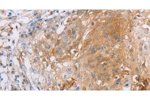 Immunohistochemistry of paraffin-embedded Human cervical cancer tissue using CD85d Polyclonal Antibody at dilution 1:30 (LILRB2 Antikörper)