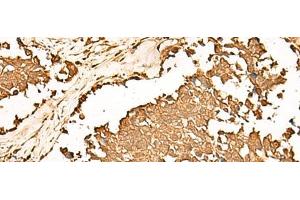 Immunohistochemistry of paraffin-embedded Human lung cancer tissue using PWP1 Polyclonal Antibody at dilution of 1:70(x200) (PWP1 Antikörper)