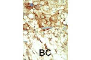 Formalin-fixed and paraffin-embedded human cancer tissue reacted with the primary antibody, which was peroxidase-conjugated to the secondary antibody, followed by DAB staining. (Ret Proto-Oncogene Antikörper  (C-Term))