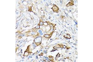 Immunohistochemistry of paraffin-embedded human lung cancer using MMP7 Rabbit pAb (ABIN3021102, ABIN3021103, ABIN3021104, ABIN1513214 and ABIN6213952) at dilution of 1:150 (40x lens). (MMP7 Antikörper  (AA 18-267))