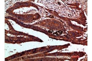 Immunohistochemical analysis of paraffin-embedded human-colon-cancer, antibody was diluted at 1:200 (CDK6 Antikörper  (AA 280-325))