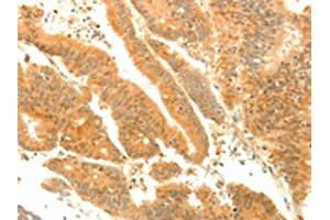 The image on the left is immunohistochemistry of paraffin-embedded Human colon cancer tissue using ABIN7131139(SOCS6 Antibody) at dilution 1/35, on the right is treated with fusion protein. (SOCS6 Antikörper)