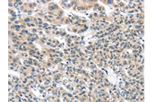 The image on the left is immunohistochemistry of paraffin-embedded Human liver cancer tissue using ABIN7131349(THSD1 Antibody) at dilution 1/25, on the right is treated with fusion protein. (THSD1 Antikörper)