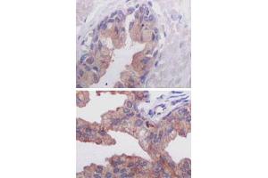 Immunohistochemical analysis of paraffin-embedded human normal prostate tissue (A) and prostate adenocarcinoma tissue (B), showing cytoplasmic localization using AMACR monoclonal antibody, clone 2A10F3  with DAB staining. (AMACR Antikörper)