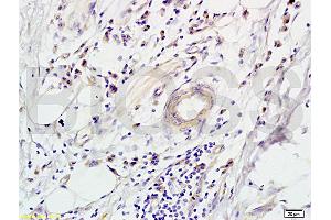 Formalin-fixed and paraffin-embedded human colon carcinoma labeled with Rabbit Anti-CD118 Polyclonal Antibody (ABIN686827), Unconjugated 1:200 followed by conjugation to the secondary antibody and DAB staining