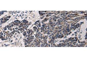 Immunohistochemistry of paraffin-embedded Human colorectal cancer tissue using CCNI Polyclonal Antibody at dilution of 1:65(x200) (Cyclin I Antikörper)