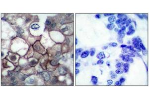 Immunohistochemical analysis of paraffin-embedded human breast carcinoma tissue using EGFR(Phospho-Tyr1197) Antibody(left) or the same antibody preincubated with blocking peptide(right).