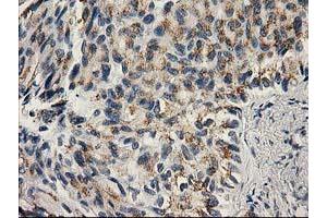 Immunohistochemical staining of paraffin-embedded Carcinoma of Human lung tissue using anti-PNMT mouse monoclonal antibody.