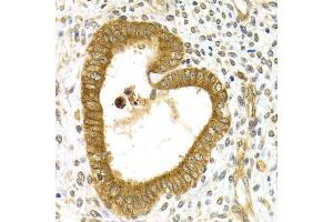 Immunohistochemistry of paraffin-embedded human adenomyosis using RAB27A Antibody (ABIN5970998) at dilution of 1/200 (40x lens). (RAB27A Antikörper)