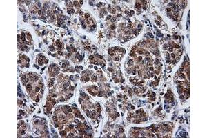 Immunohistochemical staining of paraffin-embedded Carcinoma of liver tissue using anti-PPME1mouse monoclonal antibody. (PPME1 Antikörper)
