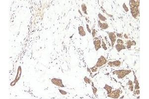 This antibody stained formalin-fixed, paraffin-embedded sections of human breast invasive ductal carcinoma.