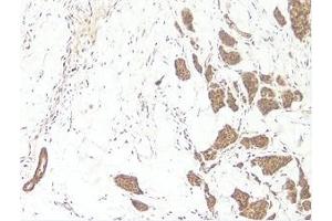 This antibody stained formalin-fixed, paraffin-embedded sections of human breast invasive ductal carcinoma. (WNT3A Antikörper)