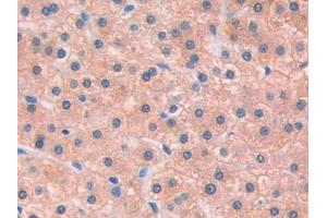 IHC-P analysis of Human Liver cancer Tissue, with DAB staining. (IL13 Receptor alpha 1 Antikörper  (AA 203-376))