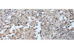 Immunohistochemistry of paraffin-embedded Human lung cancer tissue using UBR2 Polyclonal Antibody at dilution of 1:55(x200) (UBR2 Antikörper)