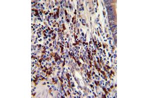 Formalin-fixed and paraffin-embedded human colon carcinoma with CNOT8 Antibody (C-term), which was peroxidase-conjugated to the secondary antibody, followed by DAB staining. (CNOT8 Antikörper  (C-Term))