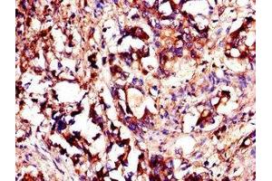 Immunohistochemistry of paraffin-embedded human gastric cancer using ABIN7174080 at dilution of 1:100 (YES1 Antikörper  (AA 1-155))